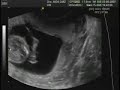 Embarazo 12 semanas Embarazo 12 semanas