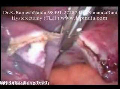 Laparoscopy Hysterectomy: TLH LAVH ...