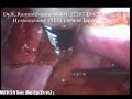 Laparoscopy Hysterectomy: TLH LAVH Full Video (Lap Uterus