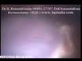 Laparoscopy Hysterectomy: TLH LAVH Full Video (Lap Uterus