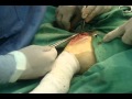 Ruptura ligamento cruzado caninos , cirugia