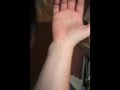 videos de Public Service Announcement: When a Burn Goes Bad...