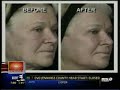 Dr Zachary discusses Fraxel Re:pair on NBC\ Dr Zachary discusses Fraxel Re:pair on NBC\