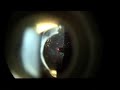 Yag Capsulotomy- for \"after cataract\" lens capsule clouding
