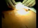 ASS SURGERY CYST