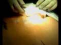 videos de ASS SURGERY CYST