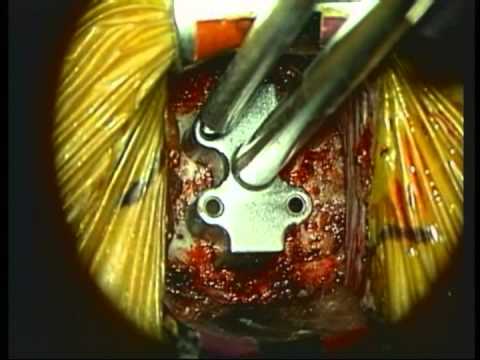 Joint Reconstruction With A Prestige Type Disc