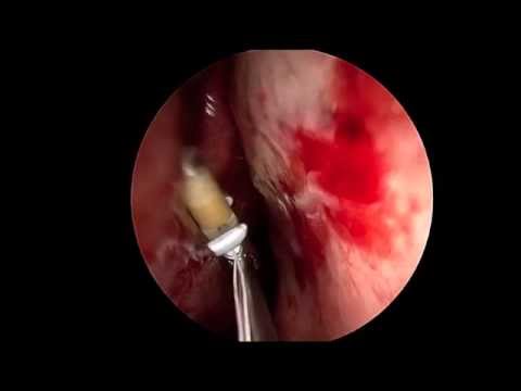 how to drain maxillary sinus