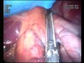 Laparoscopic Sleeve Gastrectomy-???????? ??????