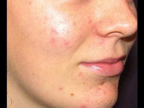how to care acne skin home remedies