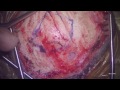 Occipital Craniotomy For Resection of Malignant Glial Tumor