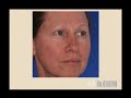 chemical-peel-facial-rejuvenation-dr-cruise-orange-count.html