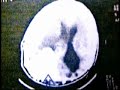 MENINGIOMA HEMORRAGICO TRAUMATICO