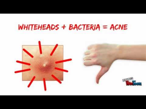 how to unclog whiteheads