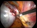 www.oxfordgynaecology.com A short video demonstrating laparoscopic removal of the ovaries and fallopian tubes, performed at the John Radcliffe Hospital Oxford. Laparoscopic oophorectomy is the surgical removal of an ovary through keyhole incisions. The removal of an ovary together with the fallopian tube is called salpingo-oophorectomy. When both ovaries and both Fallopian tubes are removed, the term bilateral salpingo-oophorectomy (BSO) is used. When it is necessary to remove the ovary? Oophorectomy is usually performed because of diseases such as ovarian cysts or endometriosis. Normal non diseased ovaries are sometimes also removed as a prophylactic procedure to prevent ovarian cancer later in life. This is particularly appropriate in women with a family history of ovarian cancer and/or with genetic polymorphisms such as BRCA1/BRCA2 (A 