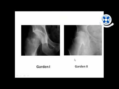 Fracturas de cadera