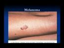 Chapter 9 - BRCH Lecture Series on Dermatology Chapter 9 - BRCH Lecture Series on Dermatology