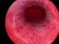 Hysteroscopy - normal Intra-uterine cavity.
