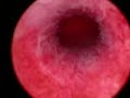Hysteroscopy - normal Intra-uterine cavity.