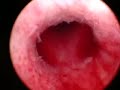 Hysteroscopy - normal Intra-uterine cavity.