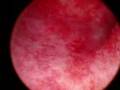 Hysteroscopy - normal Intra-uterine cavity.