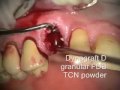 Implant Microsurgery: Transition with Extraction and Bone Graft
