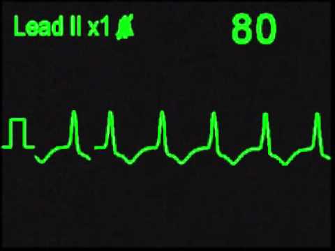 how to treat idioventricular rhythm