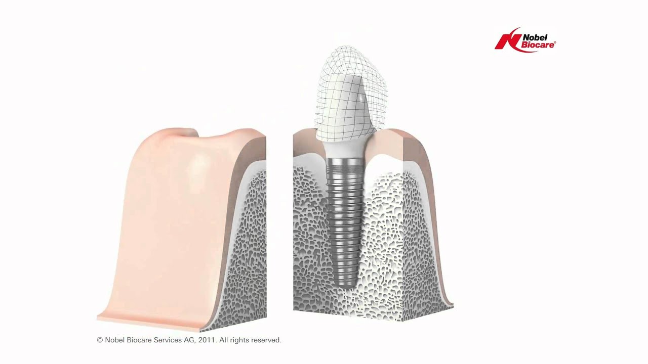 Single Tooth Dental Implant Solution