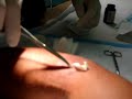 Brown Recluse Bite