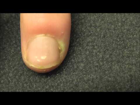 how to relieve fingernail pain