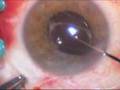 Macular pucker removal and repositioning of decentered IOL