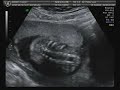 20 week 2 Day Ultrasound(Its a boy!).avi