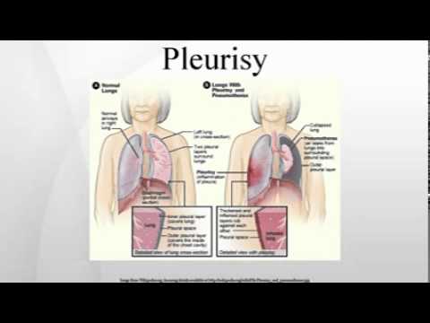 how to relieve pleurisy