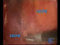 Abdominoperineal resection , laparoscopic aproach Abdominoperineal resection , laparoscopic aproach