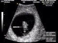Nuestro Bebe, Ecograf�a 1