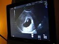 First Ultrasound at 6 weeks 3 days