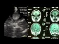 Pocket-Sized Examination During Surgery Of The Vermis Medular Tumor (Cerebellum) Pocket-Sized Examination During Surgery Of The Vermis Medular Tumor (Cerebellum)