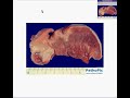 Histopathology Tongue -- Squamous cell carcinoma