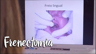 Frenectomia