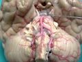 Sistema arterial cerebral cerebral arteries