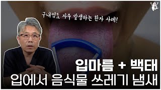 입마름과 백태, 입안의 음식 쓰레기 냄새