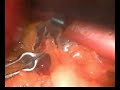 Cirugia Antireflujo pot Laparoscopia parte I