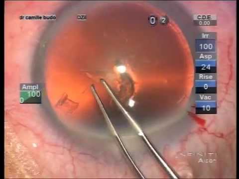 Quadrimax implantation