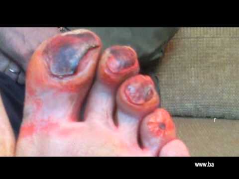 how to treat circulation problems