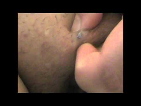 Popping pelvic abscess