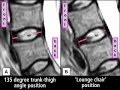 Positional MRI dispels conventional wisdom on posture