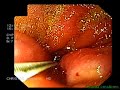 DUODENUM STENT KARALIS 255DVD.mpg