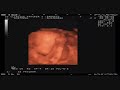 Baby 3D Ultrasound