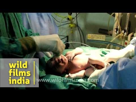 how to perform c-section delivery