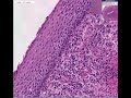 Histopathology Cervix- - Squamous cell carcinoma